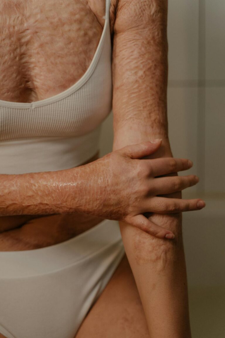 Close-up of a woman with burn scars showcasing resilience and strength.