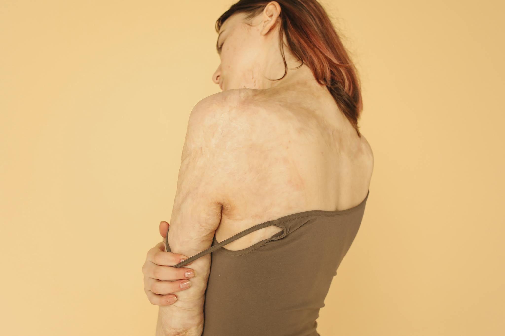 Woman with burn scars in brown tank top on beige background, showcasing resilience.
